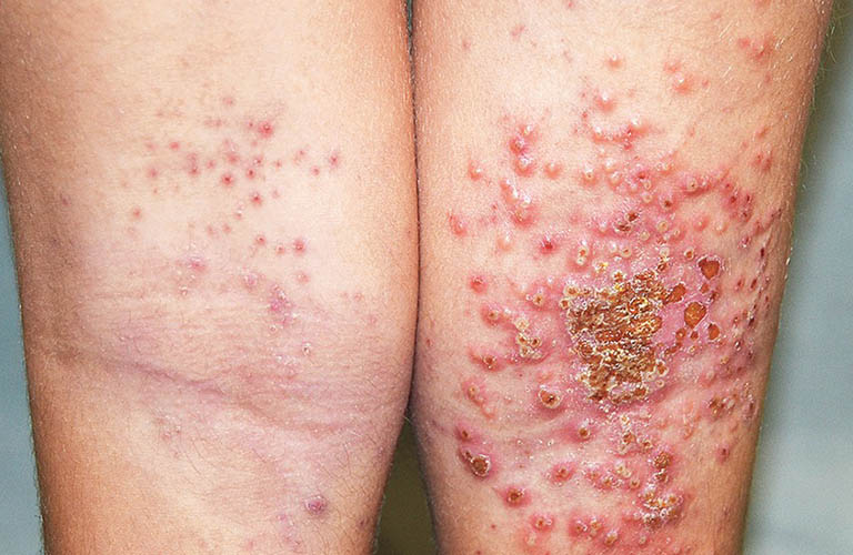 Bệnh chàm có thể gây ra tình trạng viêm nhiễm nghiêm trọng trên da