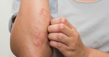 Bệnh chàm Eczema là bệnh gì? Nguyên nhân, triệu chứng và cách điều trị