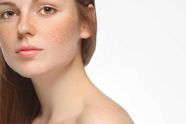 Nám, tàn nhang là biểu hiện của các hắc tố xuất hiện trên bề mặt da
