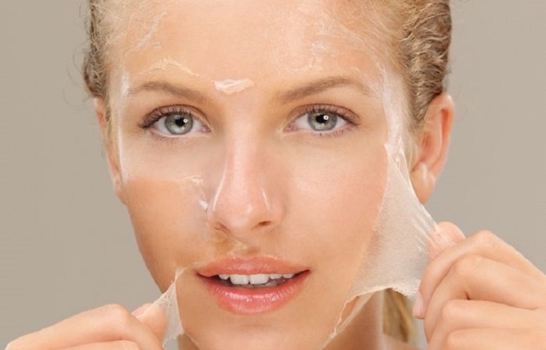 Peel da hóa học là công nghệ xóa sẹo khá phổ biến hiện nay