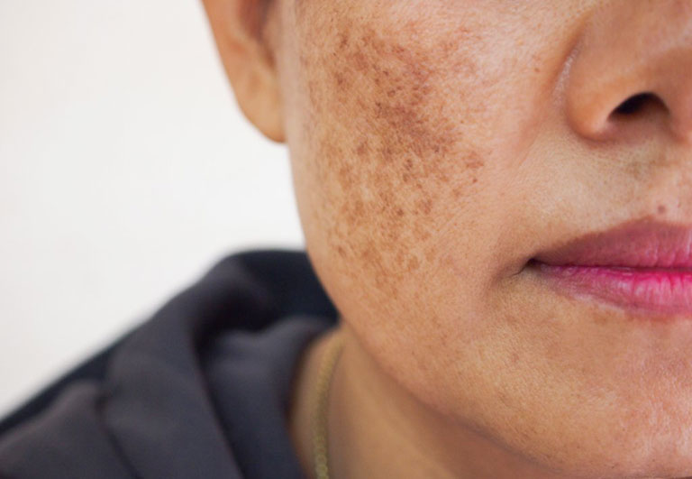 Công nghệ PRP thích hợp với những đối tượng bị nám do di truyền, tăng sắc tố da